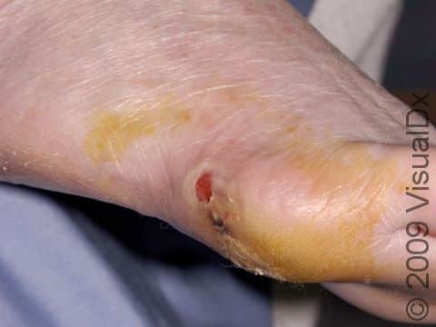 Due to an injury to the foot, an abscess formed and was then drained by the emergency doctor.