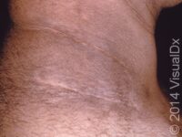 Acanthosis Nigricans