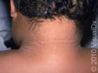 Acanthosis Nigricans