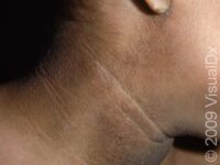 Acanthosis Nigricans