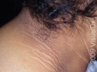 Acanthosis Nigricans