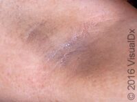 Acanthosis Nigricans