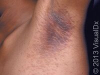 Acanthosis Nigricans