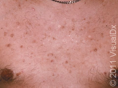 Scars displayed as dark spots (hyperpigmentation) with virtually no active acne on chest are a sign that the patient is picking and squeezing the lesions.