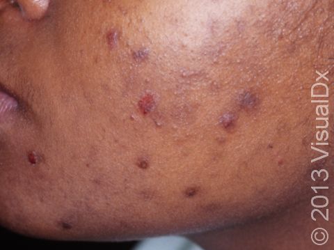 This image displays the result of squeezing and picking at acne on people with darker skin.