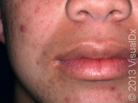 This image displays acne lesions that have been picked or squeezed.