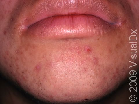 This image displays dark spots and scars, a consequence of manipulating acne lesions.