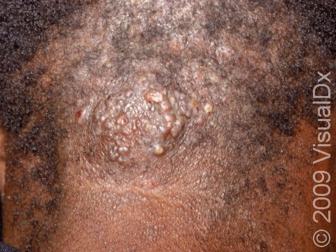 The lesions of acne keloidalis nuchae can be focused in a limited area at the back of the neck or scalp, as displayed in this image.