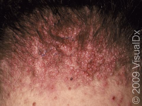 Numerous smooth, scar-like, small, raised lesions at the back of the neck are typical of acne keloidalis nuchae.