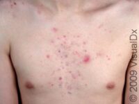 Acne (Acne Vulgaris)