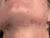 Acne (Acne Vulgaris)