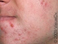 Acne (Acne Vulgaris)