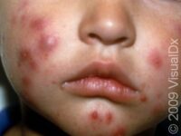 Acne (Acne Vulgaris)