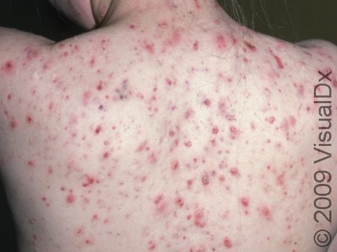 Severe cystic acne on the back can leave permanent scars.