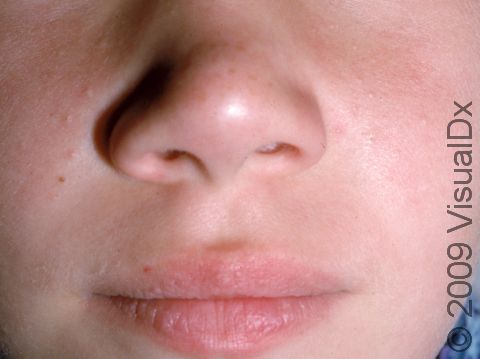 This child has several whiteheads (closed comedones) on the cheeks.