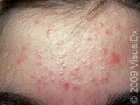 Acne (Acne Vulgaris)