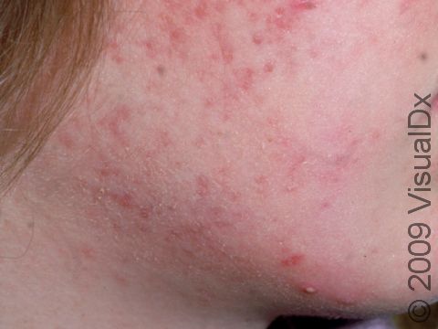 This image displays a child with acne that is starting to improve with treatment.