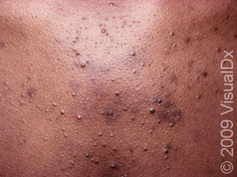 This image displays whiteheads (closed comedones) on the chest.