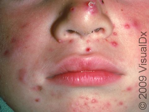 This image displays a three-year-old child with whiteheads (closed comedones) on the chin, a cyst on the nose tip, and multiple pus-filled lesions around the nose.