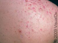 Acne (Acne Vulgaris)