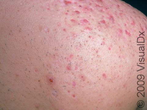 This image displays a mix of blackheads (open comedones), red bumps, and depressed scars typical of acne vulgaris.