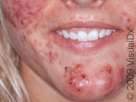 This image displays severe cystic acne.