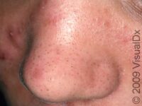 Acne (Acne Vulgaris)