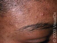 Acne (Acne Vulgaris)