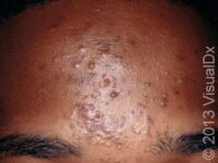 Acne (Acne Vulgaris)