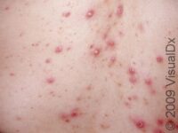 Acne (Acne Vulgaris)