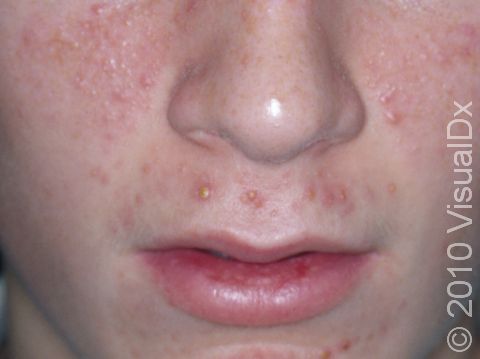 This image displays numerous pink bumps and pus-filled lesions typical of acne.