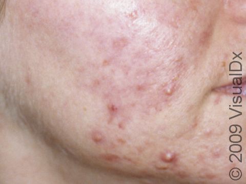 As displayed in this image, moderate and severe inflammatory acne can leave depressed scars.