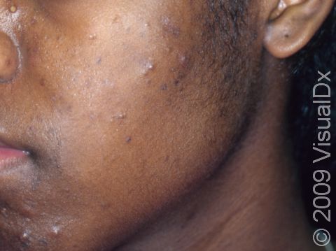 This image displays small bumps and pus-filled lesions, as well as dark, flat marks, typical of acne.