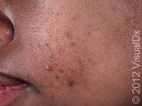 This image displays one raised acne lesion and several flat, dark spots from prior inflammation, which may take months to resolve due to the patient's darker skin.