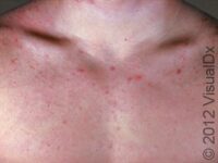 Acne (Acne Vulgaris)