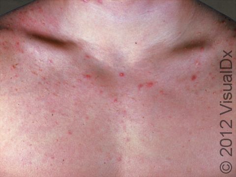 This image displays mild pus-filled lesions and bumps of acne on the chest.