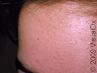 Acne (Acne Vulgaris) – Adult