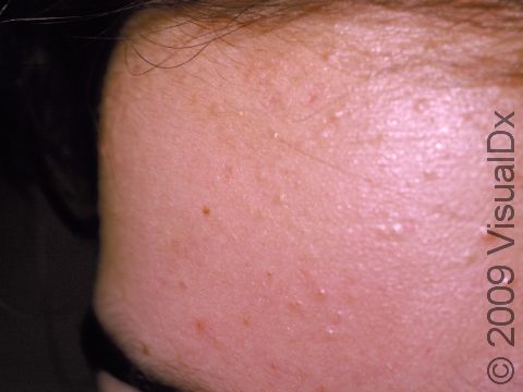 Whiteheads (closed comedones) are the earliest lesions of acne.