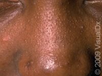 Acne (Acne Vulgaris)