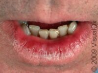 Actinic Cheilitis – Adult