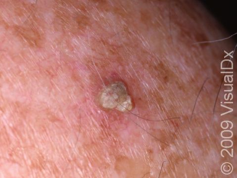 This image displays an actinic keratosis with brown spots suggesting chronic sun damage.