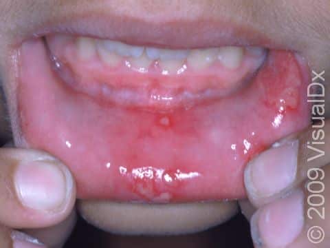 This image displays an unusually large amount of canker sores of the lower inner lip.