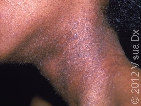 This image displays atopic dermatitis involving the cheeks and neck.