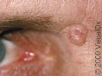 Basal Cell Carcinoma (BCC) – Adult