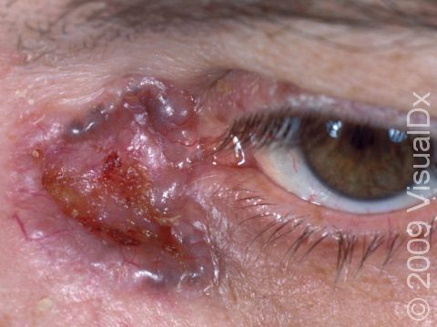 This nodular basal cell carcinoma displays a 