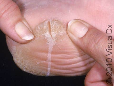 This image displays a callus that has been treated with silver nitrate.