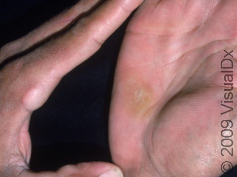 Calloses develop wherever the skin is exposed repeatedly to pressure or friction, as displayed on these hands.