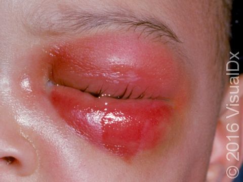 Orbital cellulitis quickly develops with redness, pain, and marked swelling around the eye.