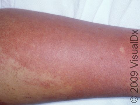 This image displays the redness (erythema) typically present in cellulitis.