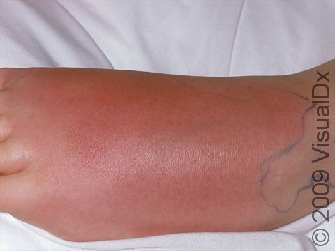 An outline defining the involved skin in patients with cellulitis is used to track improvement as antibiotics take effect.